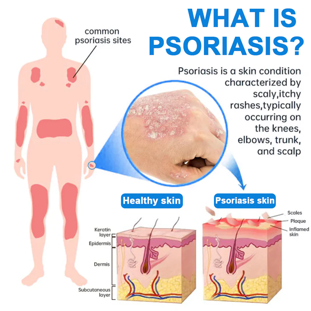 ✅ Official Store: Kubozn® Magnesium Herbal Psoriasis Spray 👨‍⚕️ MHRA Approved (Relieves psoriasis and eczema, improves bacterial infections in the genital area, treats acne and warts) (offer) - Image 2