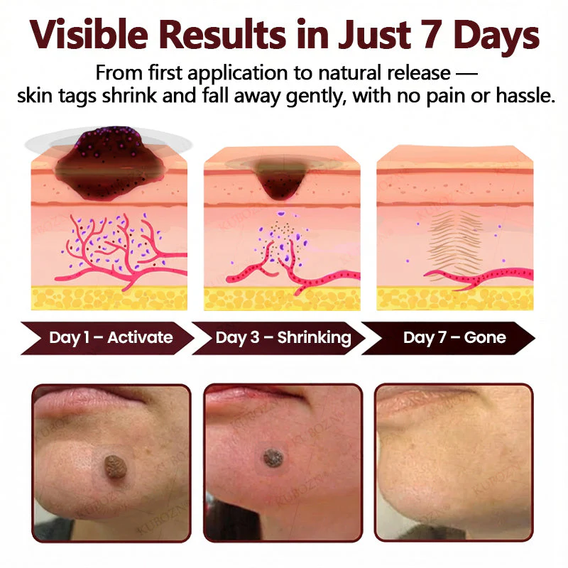 KUBOZN® OryzaDarts TAG’GONE Patch✨Pain-Free Root-Level Removal Powered by Black Rice MicroDarts. 🅱︎ - Image 4