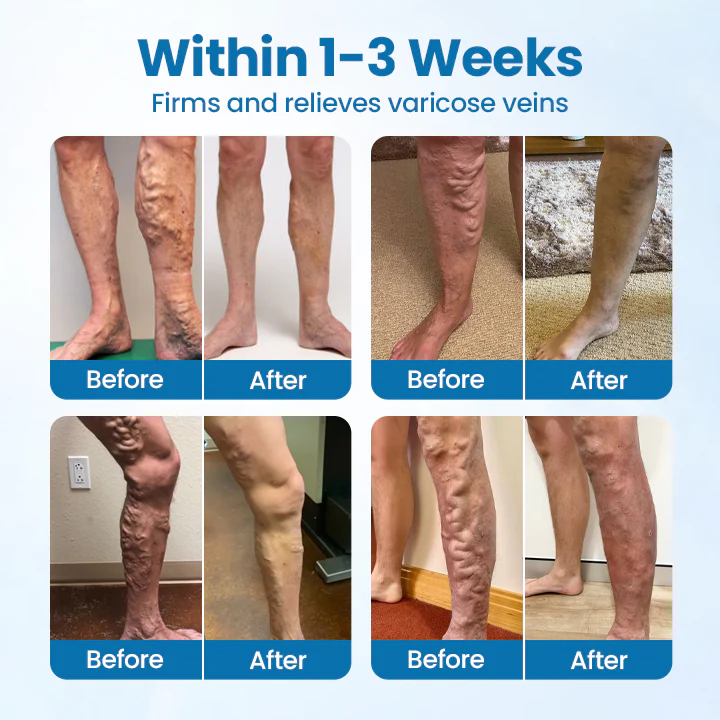 ⚡Cvreoz® VeinGuard Herbal Spray - Image 2