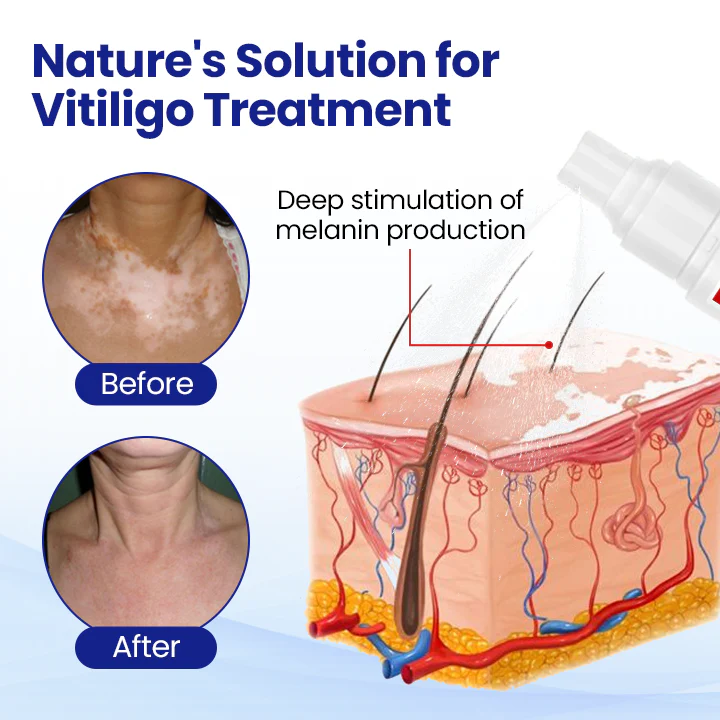 KUBOZN® Vitiligo Treatment Spray 🌿 Herbal Formula Certified — (Supports Repigmentation, Prevents New Spots, and Restores Natural Skin Tone Without Steroids) - Image 3