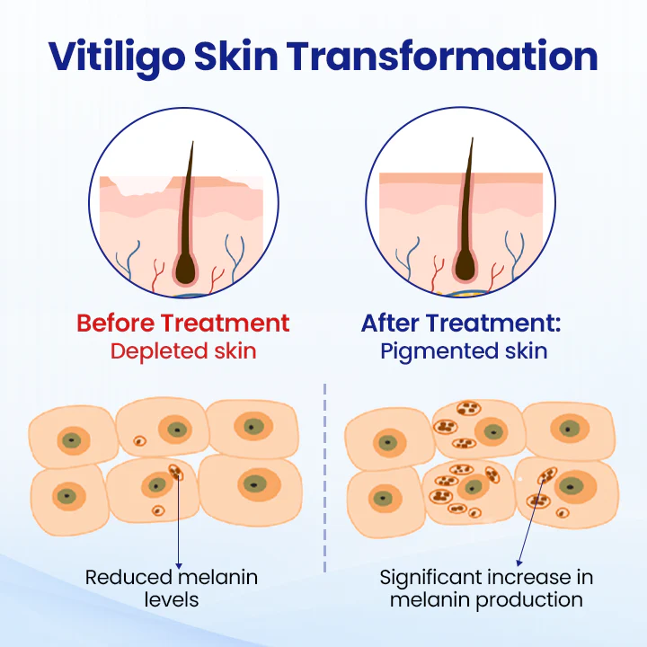 KUBOZN® Vitiligo Treatment Spray 🌿 Herbal Formula Certified — (Supports Repigmentation, Prevents New Spots, and Restores Natural Skin Tone Without Steroids) - Image 4