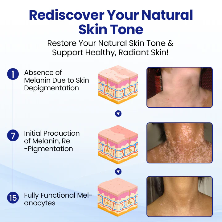 KUBOZN® Vitiligo Treatment Spray 🌿 Herbal Formula Certified — (Supports Repigmentation, Prevents New Spots, and Restores Natural Skin Tone Without Steroids) - Image 5