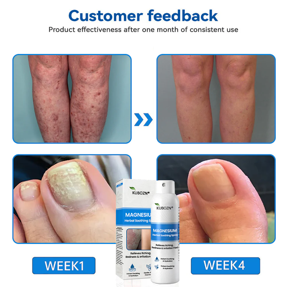 ✅ Official Store: KUBOZN® Magnesium Herbal Psoriasis Spray 👨‍⚕️ MHRA Approved (Relieves psoriasis and eczema, improves bacterial infections in the genital area, treats acne and warts) - Image 10