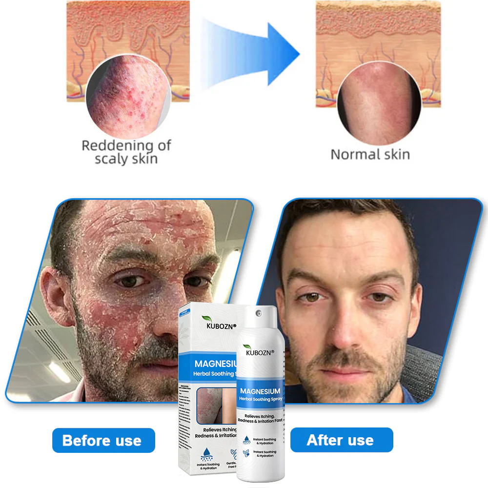 ✅ Official Store: KUBOZN® Magnesium Herbal Psoriasis Spray 👨‍⚕️ MHRA Approved (Relieves psoriasis and eczema, improves bacterial infections in the genital area, treats acne and warts) - Image 11